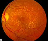 Age-related macular degeneration V15b19 Age-related macular degeneration V15b19