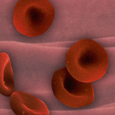 Anaemia V13D05 Anaemia V13D05