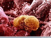 Cancer image015.jpg Cancer image015.jpg
