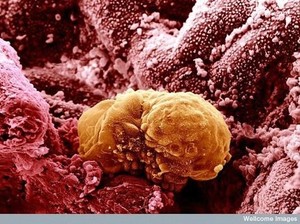 Cancer image015